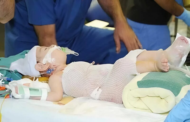 Egy kilenc órás műtét után szétválasztottak sziámi ikreket, akiknek közös emésztőrendszerük volt. Így néznek ki.