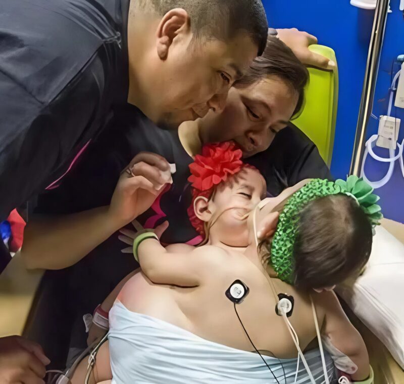 Egy kilenc órás műtét után szétválasztottak sziámi ikreket, akiknek közös emésztőrendszerük volt. Így néznek ki.