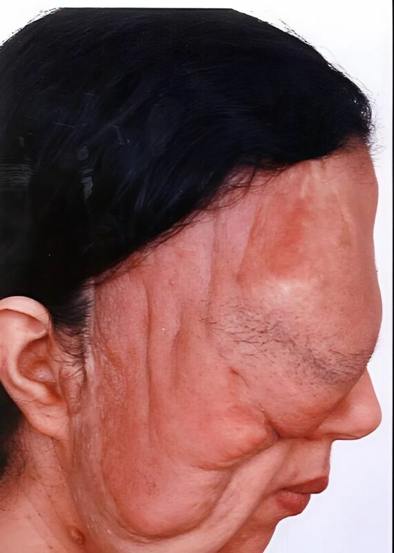 Az anya, akit a férje elutasított, miután az arcán lévő daganatok tönkretették a megjelenését, életet megváltoztató műtéten esett át, hogy helyreállítsa az arcát.