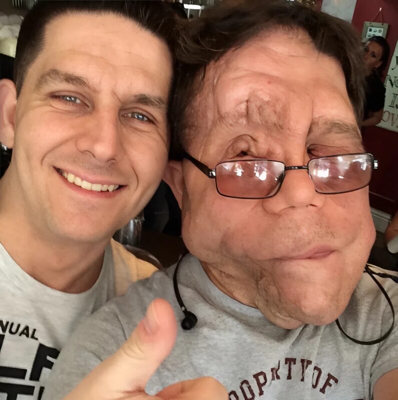 Adam Pearson utazása: egy ritka betegségben szenvedő egypetéjű ikertestvérből sztár lett – így néznek ki.