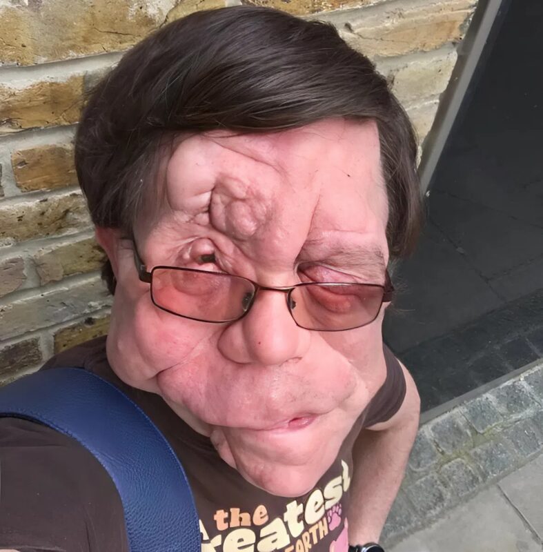 Adam Pearson utazása: egy ritka betegségben szenvedő egypetéjű ikertestvérből sztár lett – így néznek ki.