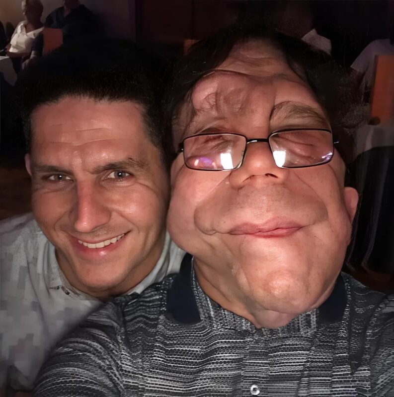 Adam Pearson utazása: egy ritka betegségben szenvedő egypetéjű ikertestvérből sztár lett – így néznek ki.