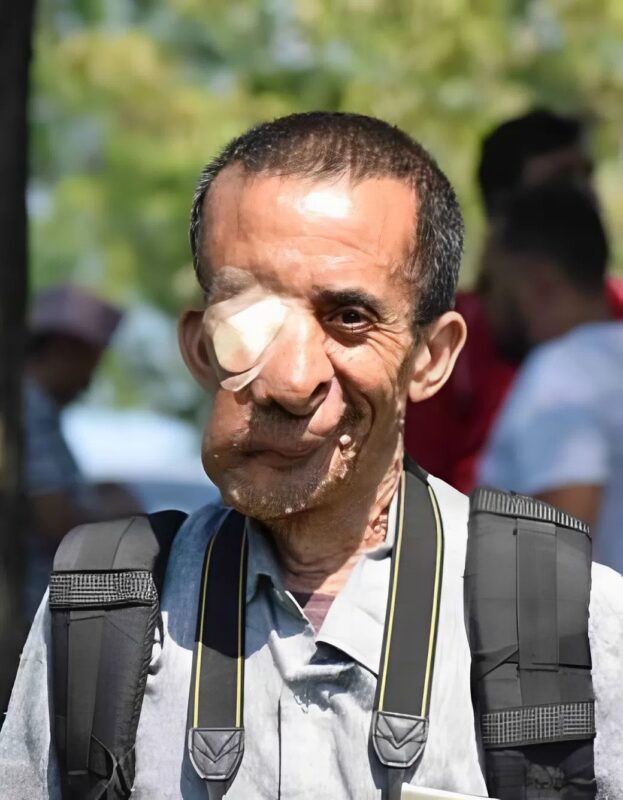 Egy nepáli férfi, akinek a daganata akkora volt, hogy fél arcát beborította, és az egyik szemét megvakította, végre el lett távolítva, miután kegyetlen idegenek ördögnek nevezték.