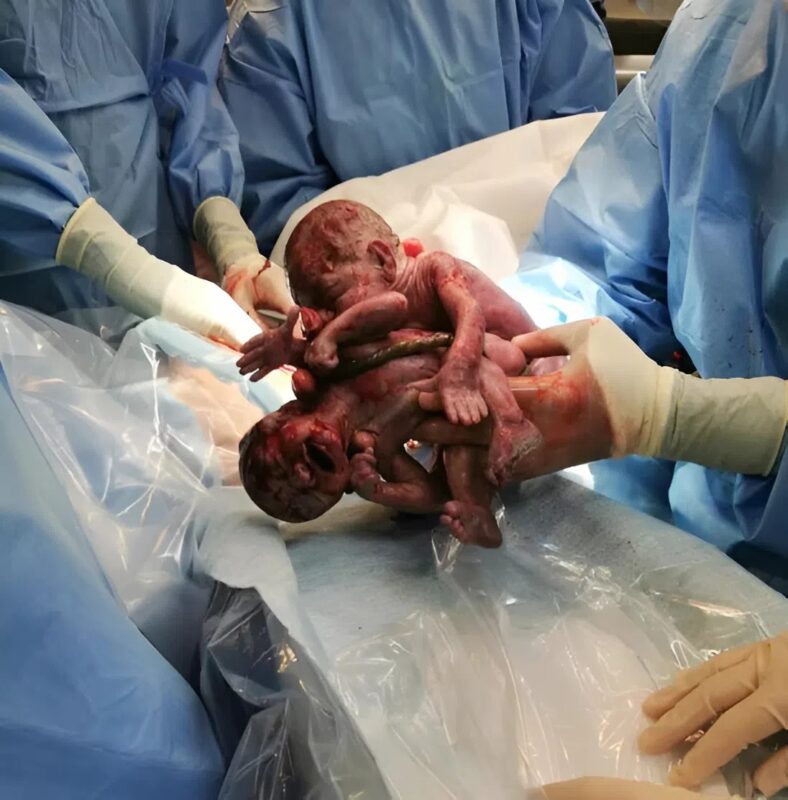 Nézd meg ezt a lenyűgöző fotót az együtt született ikertestvérekről, akik megölelik egymást.