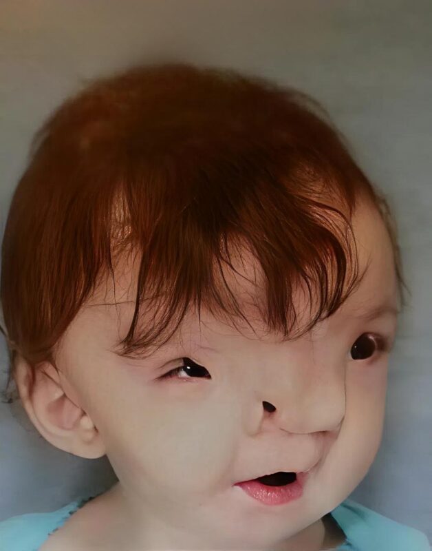 Egy kétéves kislány végre először tud mosolyogni egy nagyobb műtét után, és a 3D nyomtatás segít átalakítani az arcát. Így néz ki most.