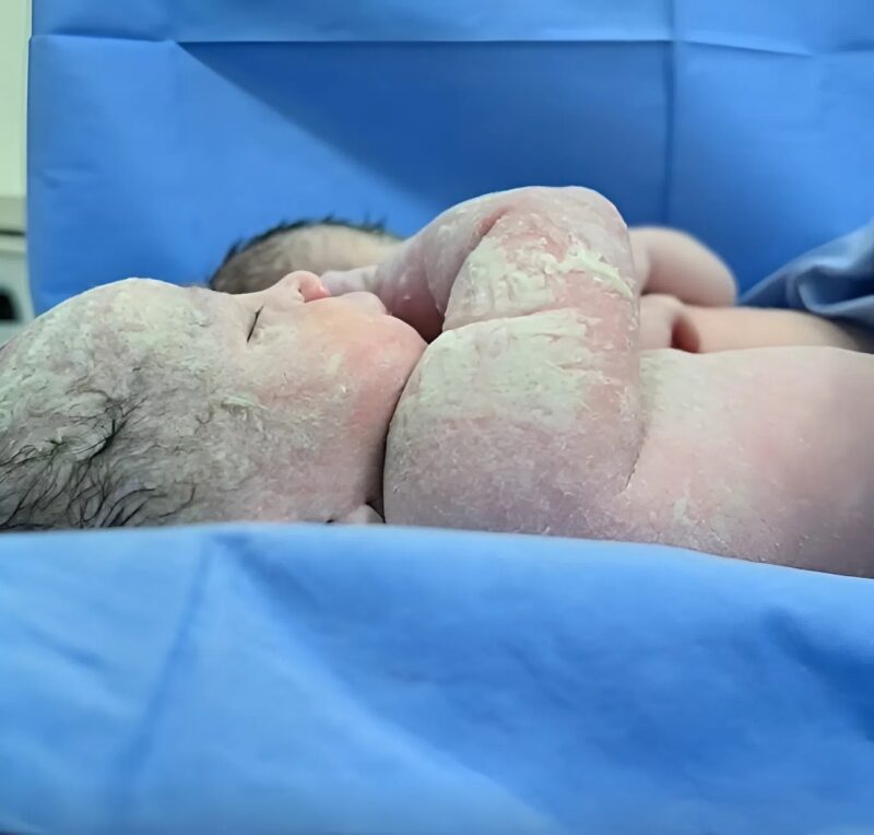 Az orvosok aggódtak a babák bőre miatt, de azon a napon, amikor hazamentek, a szülők hihetetlent fedeztek fel.