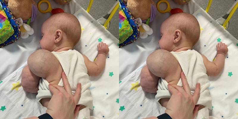 A kis Toby szülei felkészültek egy 13 órás műtétre, íme, hogyan zajlott le, és hogyan néz ki a műtét után.